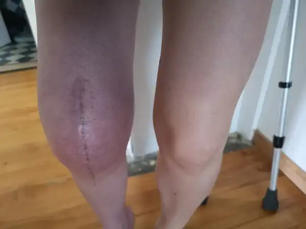 Beinprothese für Isabelle